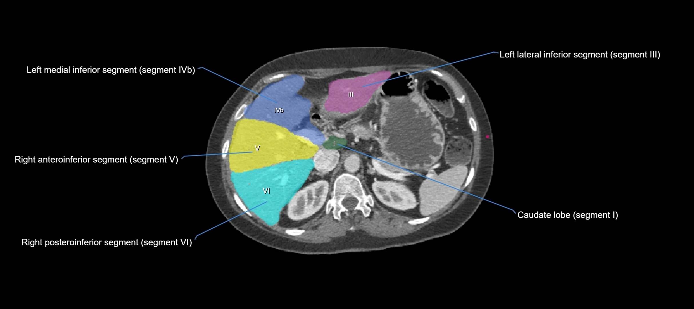 CT liver segments axial cross sectional anatomy labelled image-00044.webp